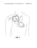 Connector for an implantable medical device diagram and image