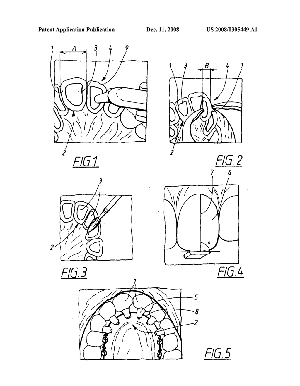 Method of preparing a surface for attaching of an orthodontic device - diagram, schematic, and image 02