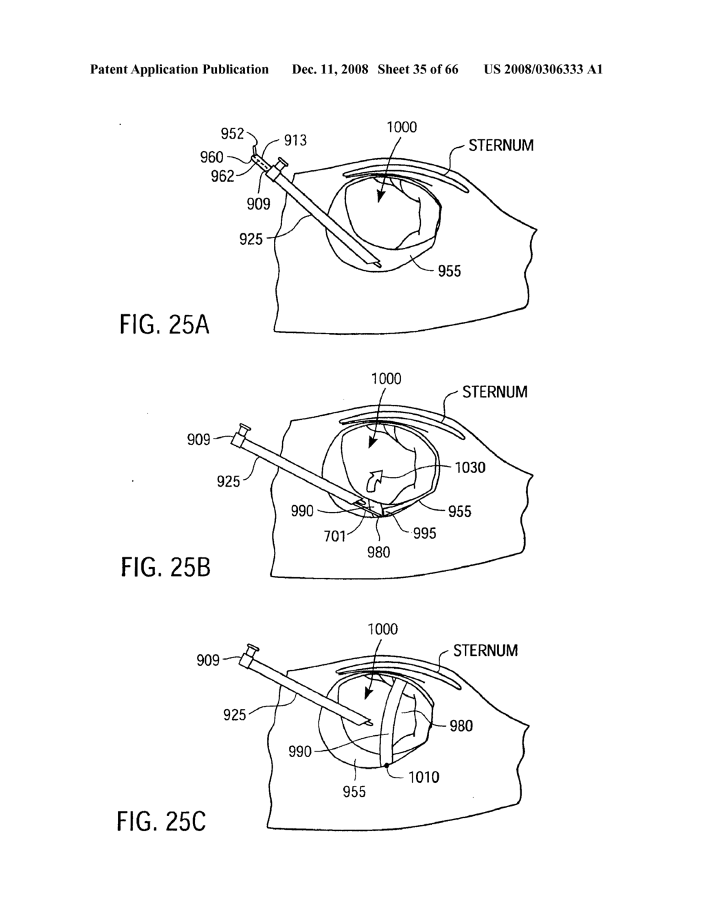 Apparatus and Method for Endoscopic Surgical Procedures - diagram, schematic, and image 36