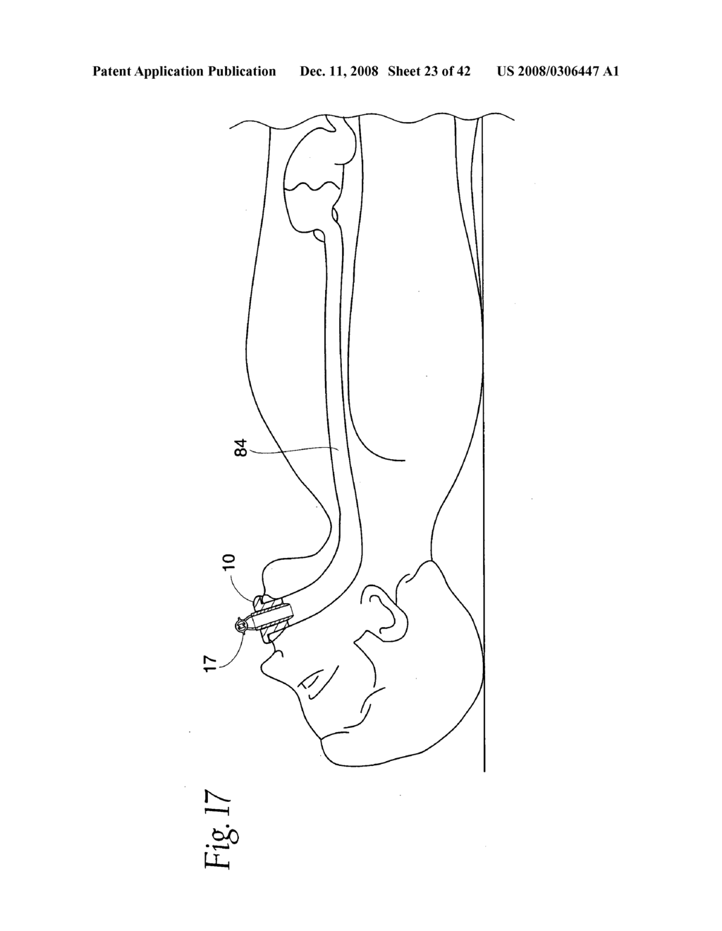 Systems and methods employing a bite block insert for positioning and stabilizing external instruments deployed within the body - diagram, schematic, and image 24