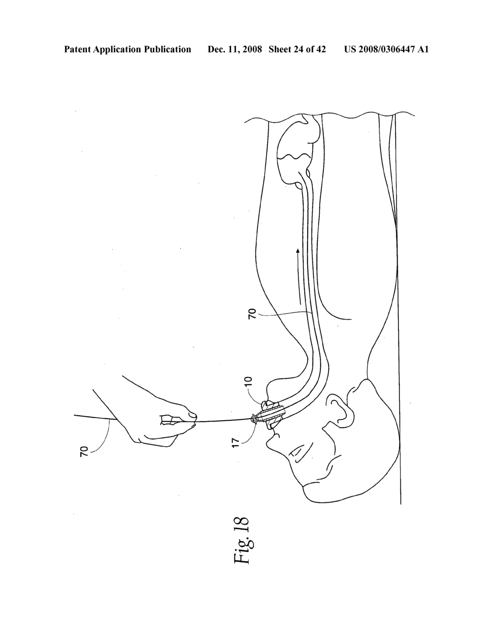 Systems and methods employing a bite block insert for positioning and stabilizing external instruments deployed within the body - diagram, schematic, and image 25