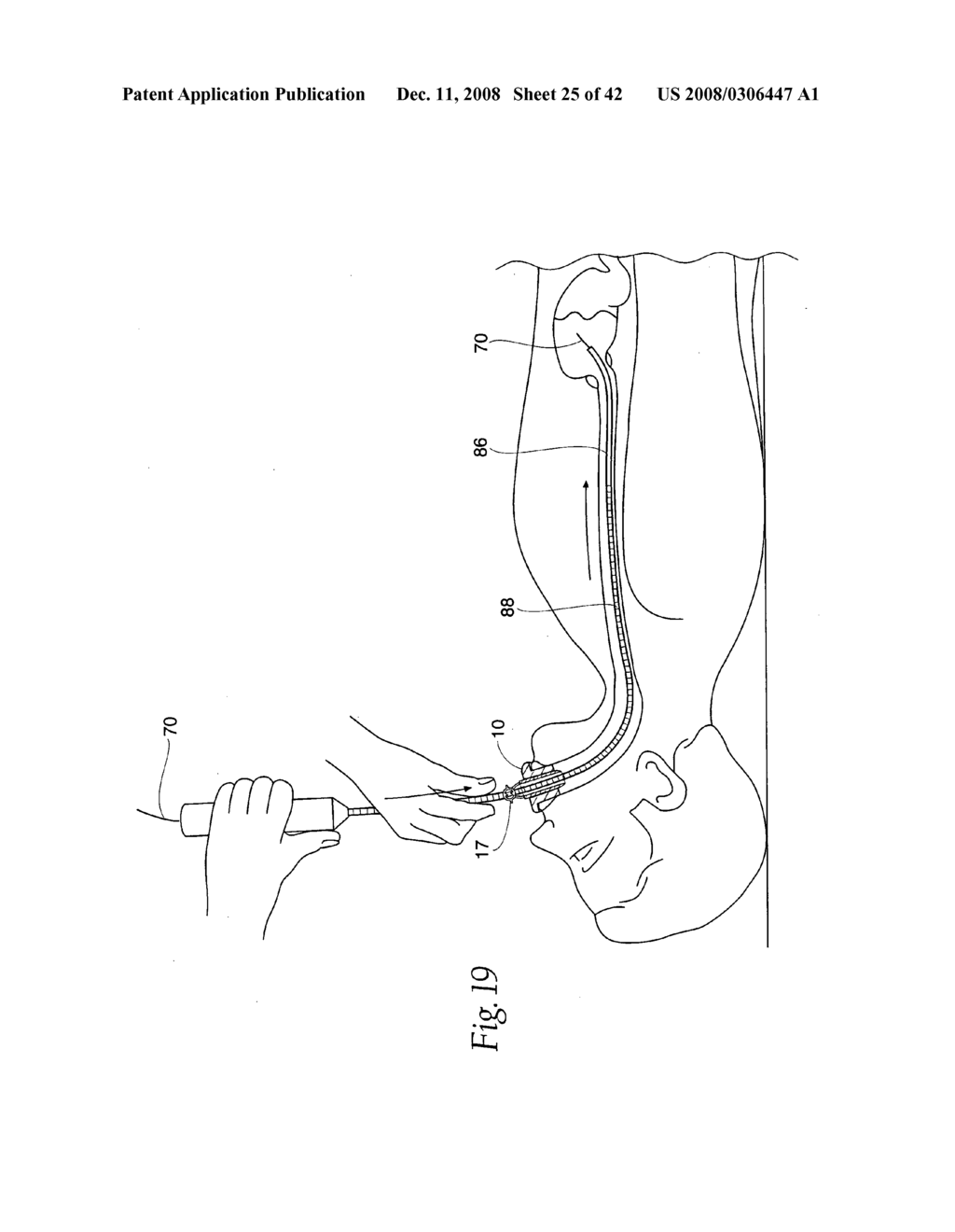 Systems and methods employing a bite block insert for positioning and stabilizing external instruments deployed within the body - diagram, schematic, and image 26