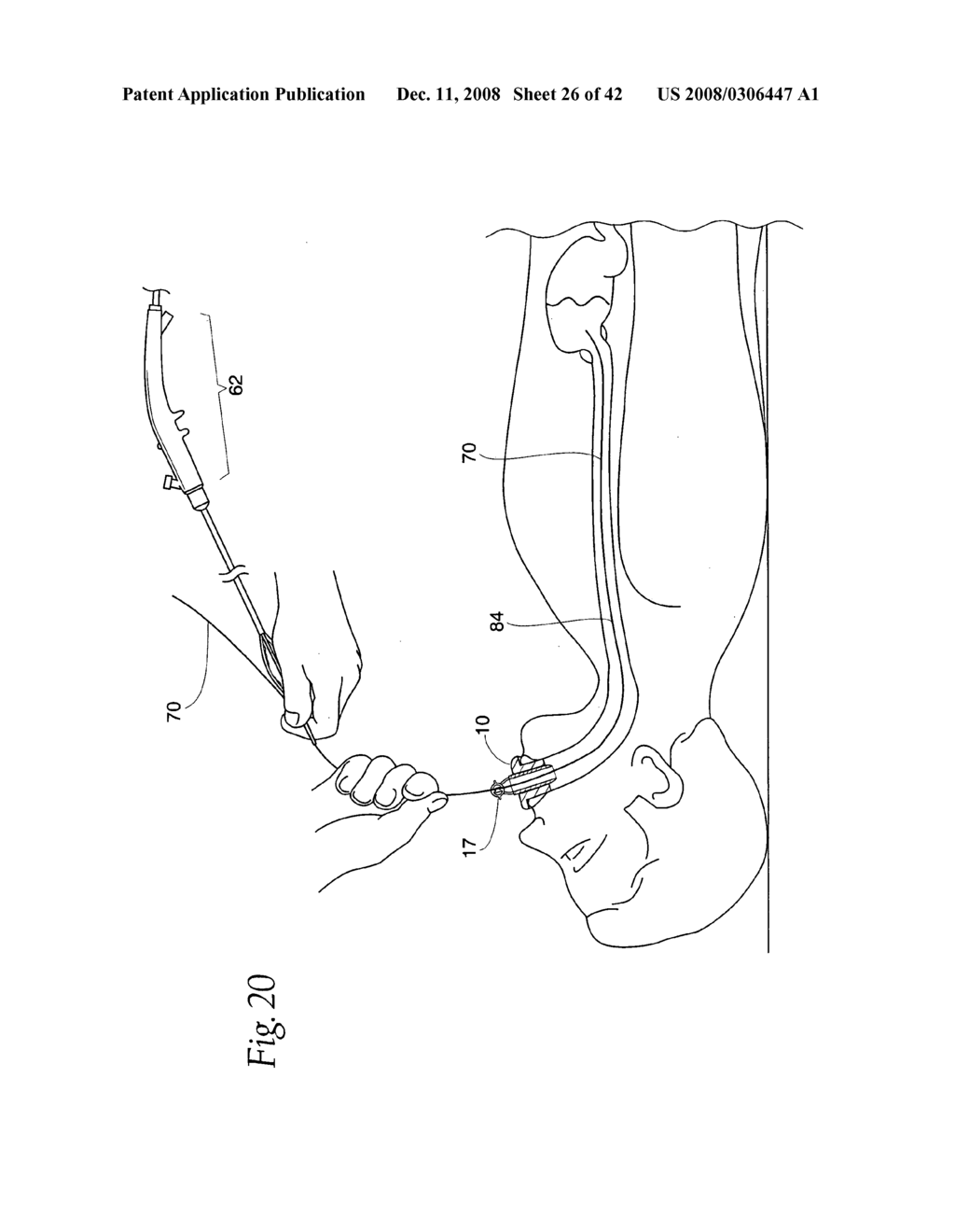 Systems and methods employing a bite block insert for positioning and stabilizing external instruments deployed within the body - diagram, schematic, and image 27