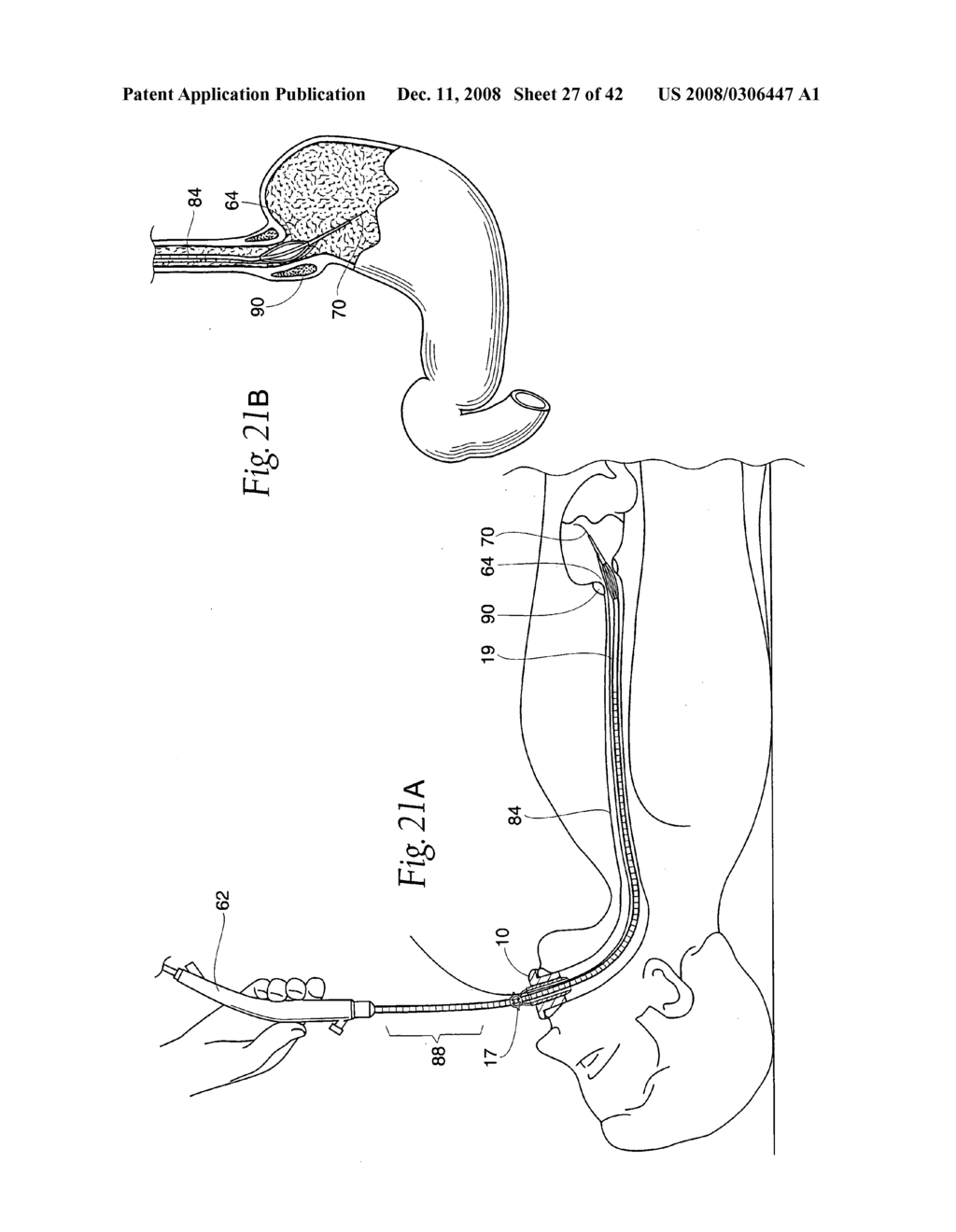 Systems and methods employing a bite block insert for positioning and stabilizing external instruments deployed within the body - diagram, schematic, and image 28