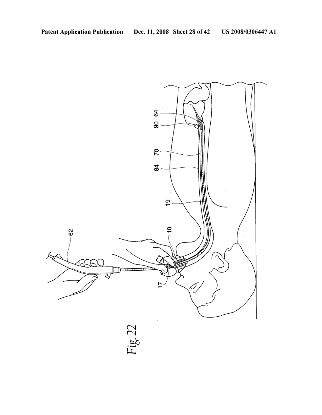 Systems and methods employing a bite block insert for positioning and stabilizing external instruments deployed within the body - diagram, schematic, and image 29