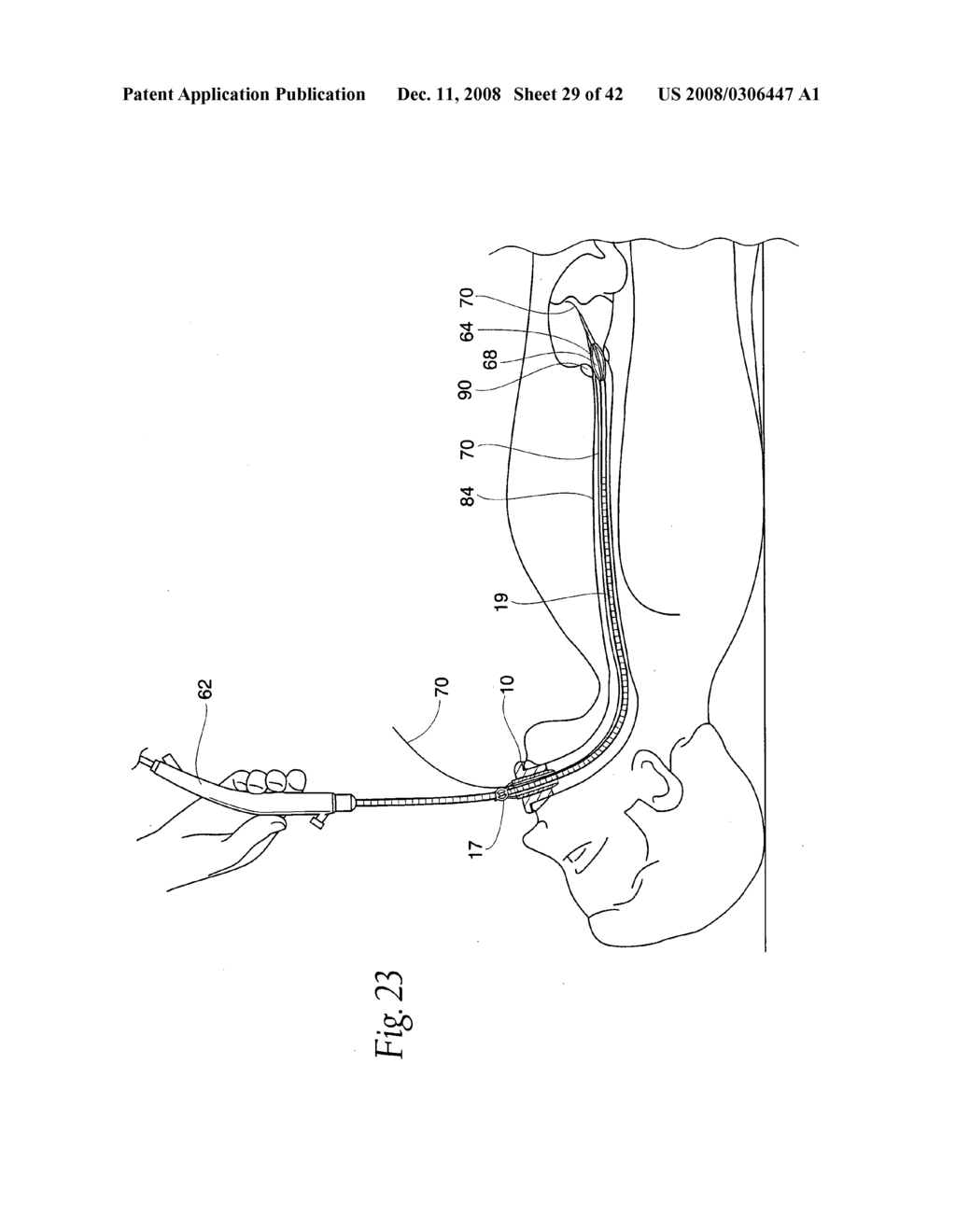 Systems and methods employing a bite block insert for positioning and stabilizing external instruments deployed within the body - diagram, schematic, and image 30