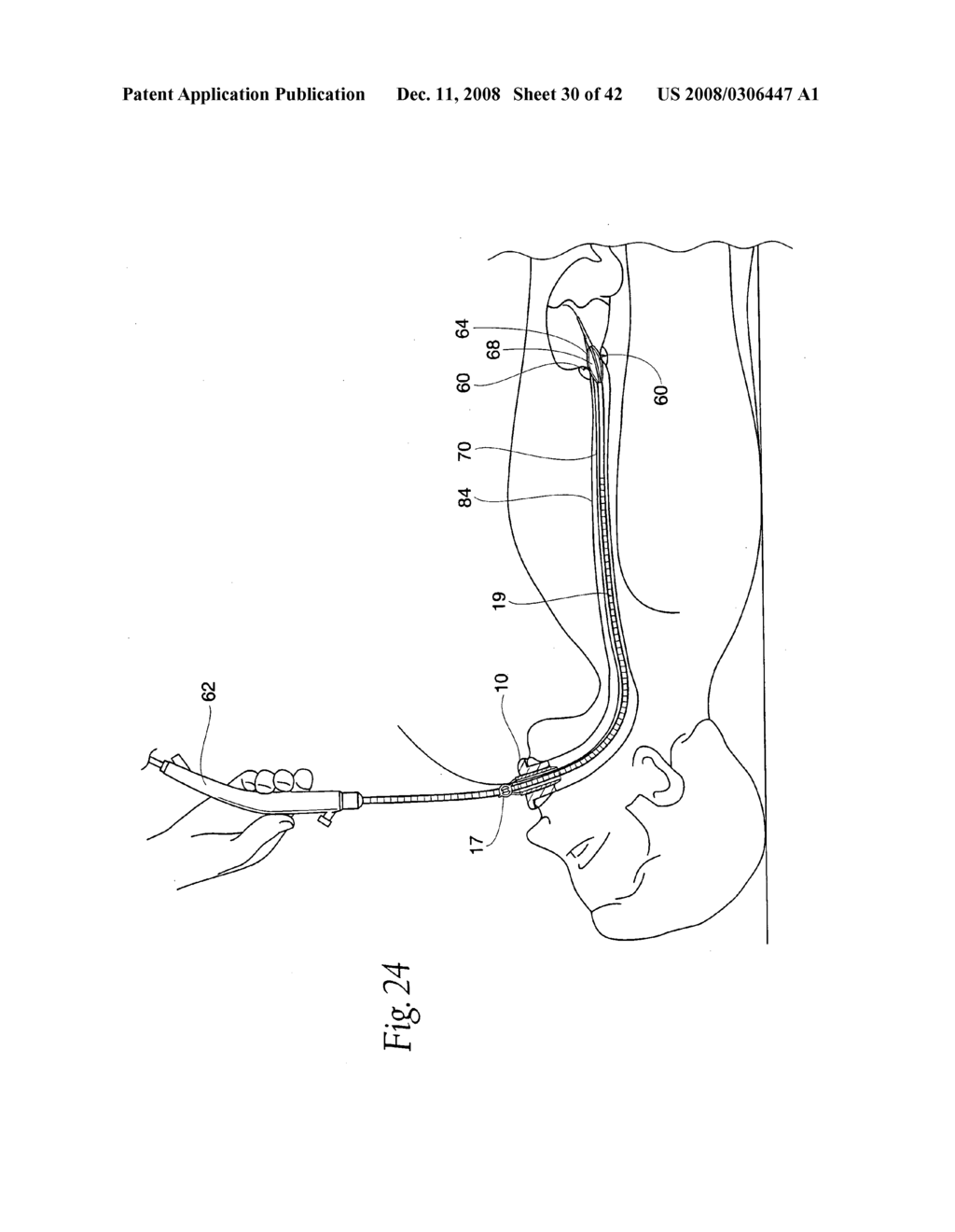 Systems and methods employing a bite block insert for positioning and stabilizing external instruments deployed within the body - diagram, schematic, and image 31