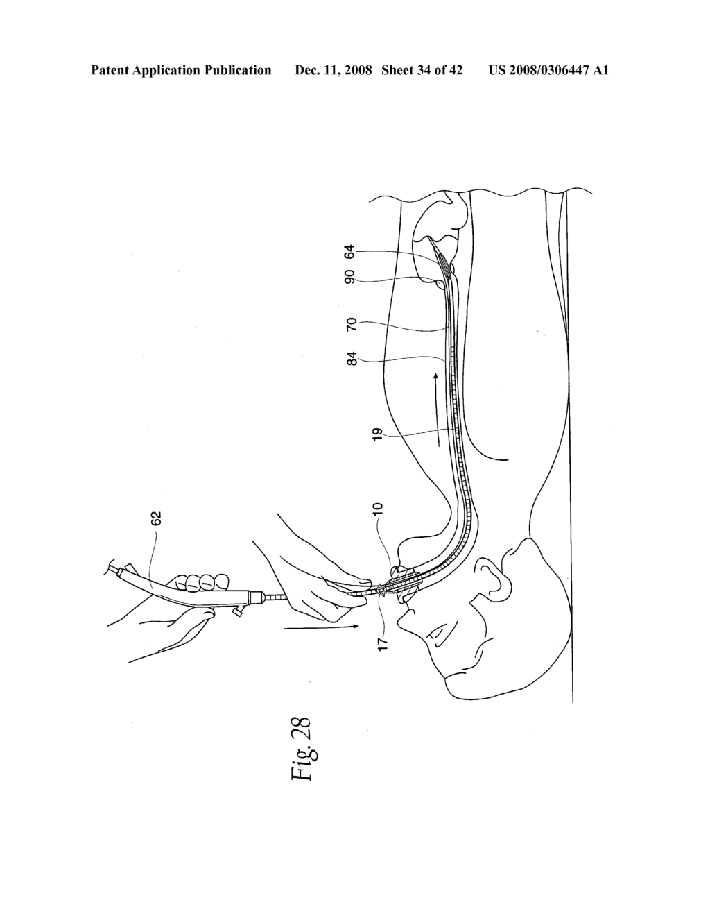 Systems and methods employing a bite block insert for positioning and stabilizing external instruments deployed within the body - diagram, schematic, and image 35