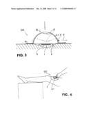 Wound Treatment Device with Elastically Deformable Vacuum-Generating Element diagram and image