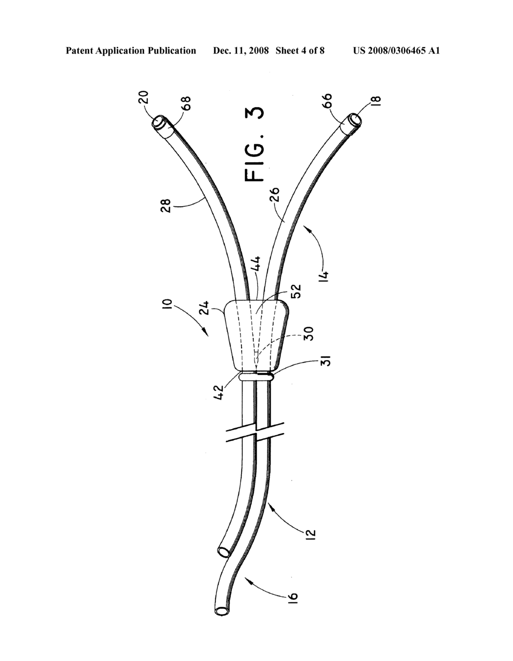 Adjustable Length Catheter - diagram, schematic, and image 05