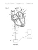 ATRIAL ABLATION CATHETER AND METHOD OF USE diagram and image