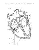 ATRIAL ABLATION CATHETER AND METHOD OF USE diagram and image