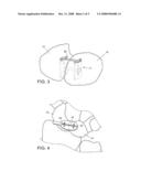 Scapho-lunate Fixation Implants and Methods of Use diagram and image