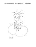 Scapho-lunate Fixation Implants and Methods of Use diagram and image