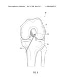 RETROGRADE CUTTING INSTRUMENT diagram and image