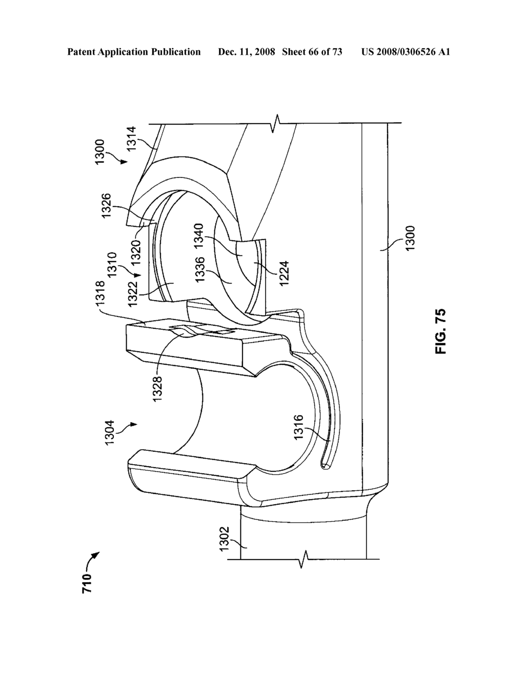 DEFLECTION ROD SYSTEM WITH A DEFLECTION CONTOURING SHIELD FOR A SPINE IMPLANT AND METHOD - diagram, schematic, and image 67