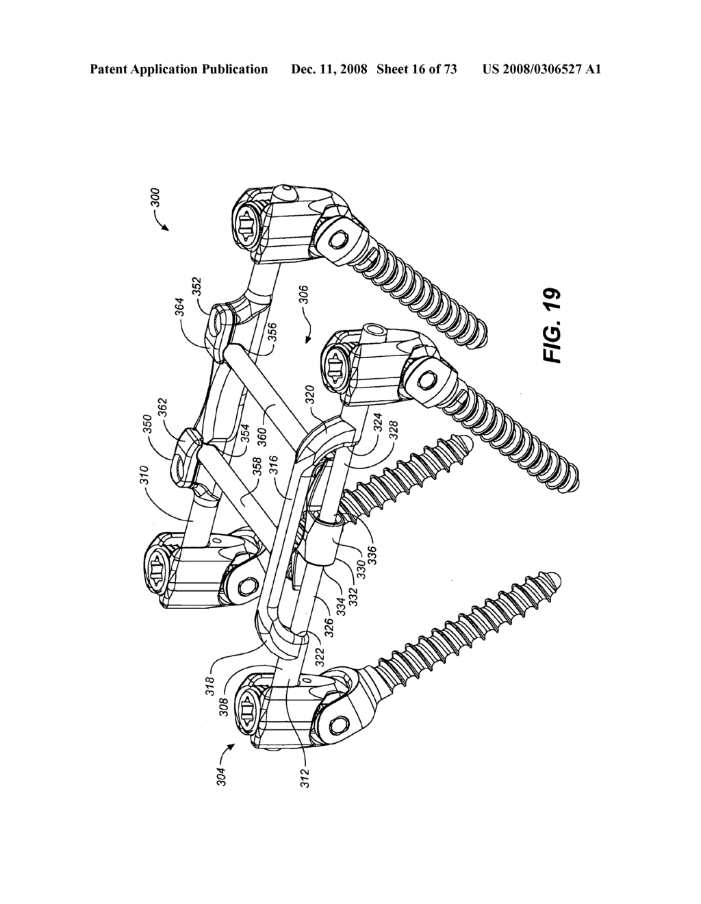 DYNAMIC STABILIZATION AND MOTION PRESERVATION SPINAL IMPLANTATION SYSTEM WITH A SHIELDED DEFLECTION ROD SYSTEM AND METHOD - diagram, schematic, and image 17