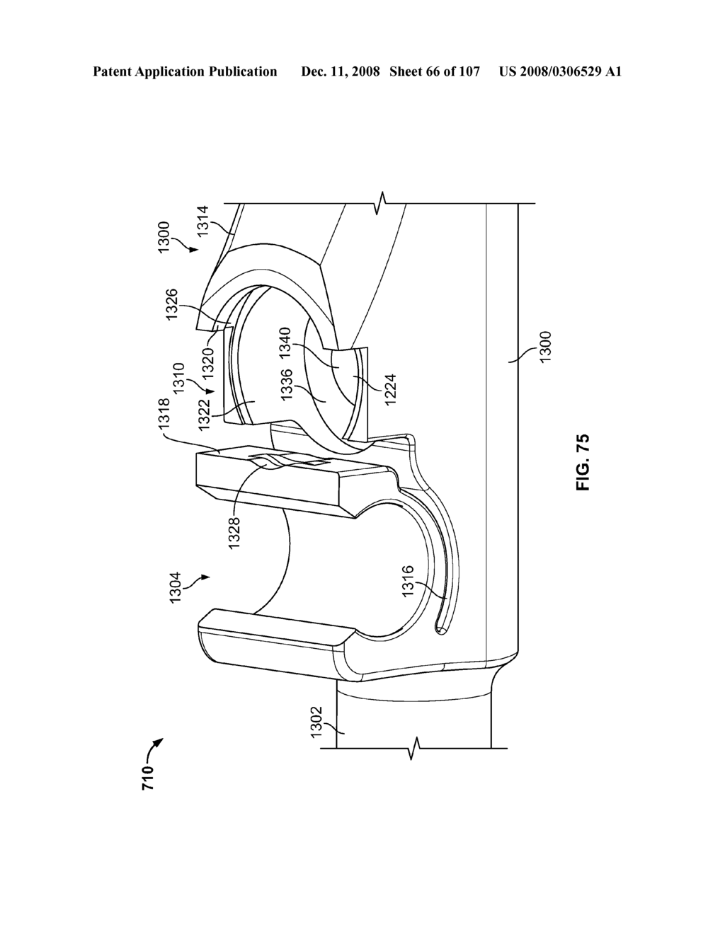 DEFLECTION ROD SYSTEM FOR A DYNAMIC STABILIZATION AND MOTION PRESERVATION SPINAL IMPLANTATION SYSTEM AND METHOD - diagram, schematic, and image 67