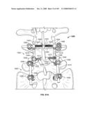 DEFLECTION ROD SYSTEM FOR USE WITH A VERTEBRAL FUSION IMPLANT FOR DYNAMIC STABILIZATION AND MOTION PRESERVATION SPINAL IMPLANTATION SYSTEM AND METHOD diagram and image