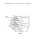 DEFLECTION ROD SYSTEM FOR USE WITH A VERTEBRAL FUSION IMPLANT FOR DYNAMIC STABILIZATION AND MOTION PRESERVATION SPINAL IMPLANTATION SYSTEM AND METHOD diagram and image