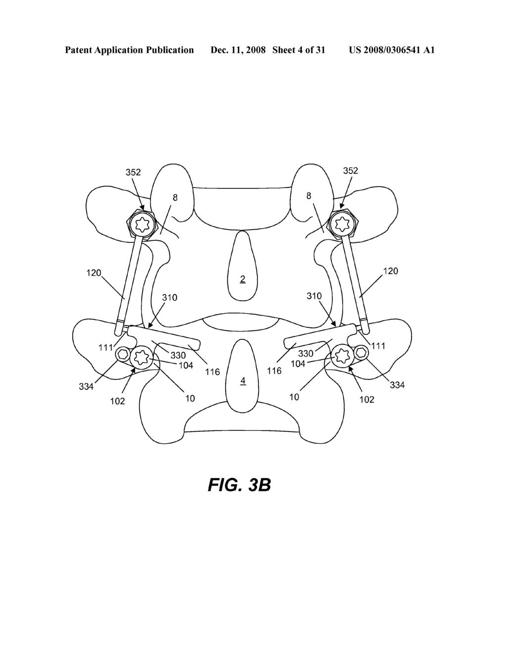 SPINE IMPLANT WITH A DUAL DEFLECTION ROD SYSTEM INCLUDING A DEFLECTION LIMITING SHEILD ASSOCIATED WITH A BONE SCREW AND METHOD - diagram, schematic, and image 05