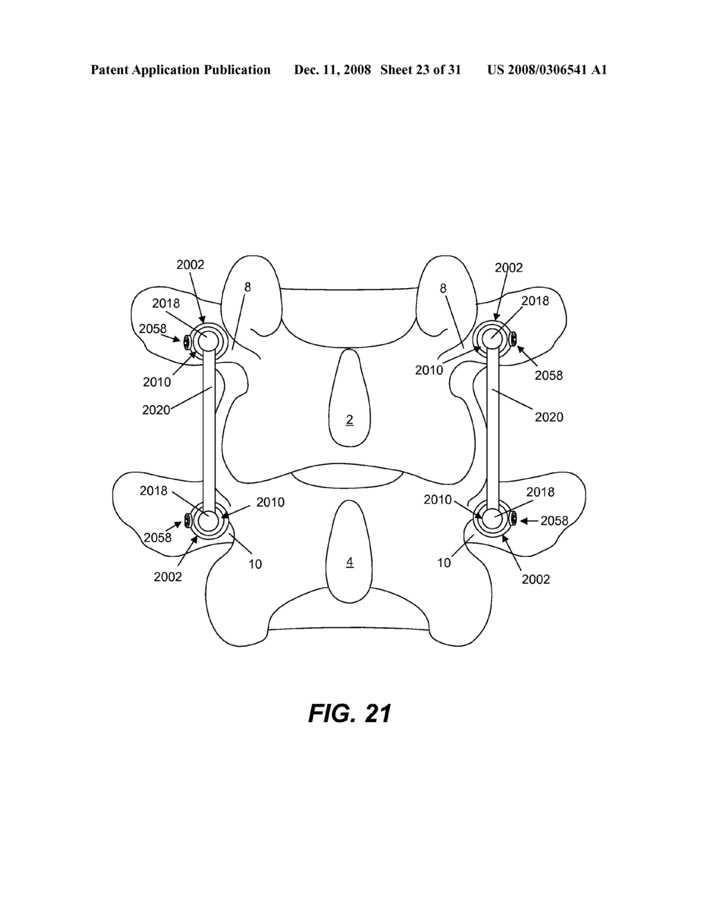 SPINE IMPLANT WITH A DUAL DEFLECTION ROD SYSTEM INCLUDING A DEFLECTION LIMITING SHEILD ASSOCIATED WITH A BONE SCREW AND METHOD - diagram, schematic, and image 24