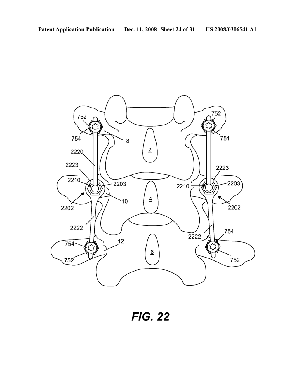 SPINE IMPLANT WITH A DUAL DEFLECTION ROD SYSTEM INCLUDING A DEFLECTION LIMITING SHEILD ASSOCIATED WITH A BONE SCREW AND METHOD - diagram, schematic, and image 25