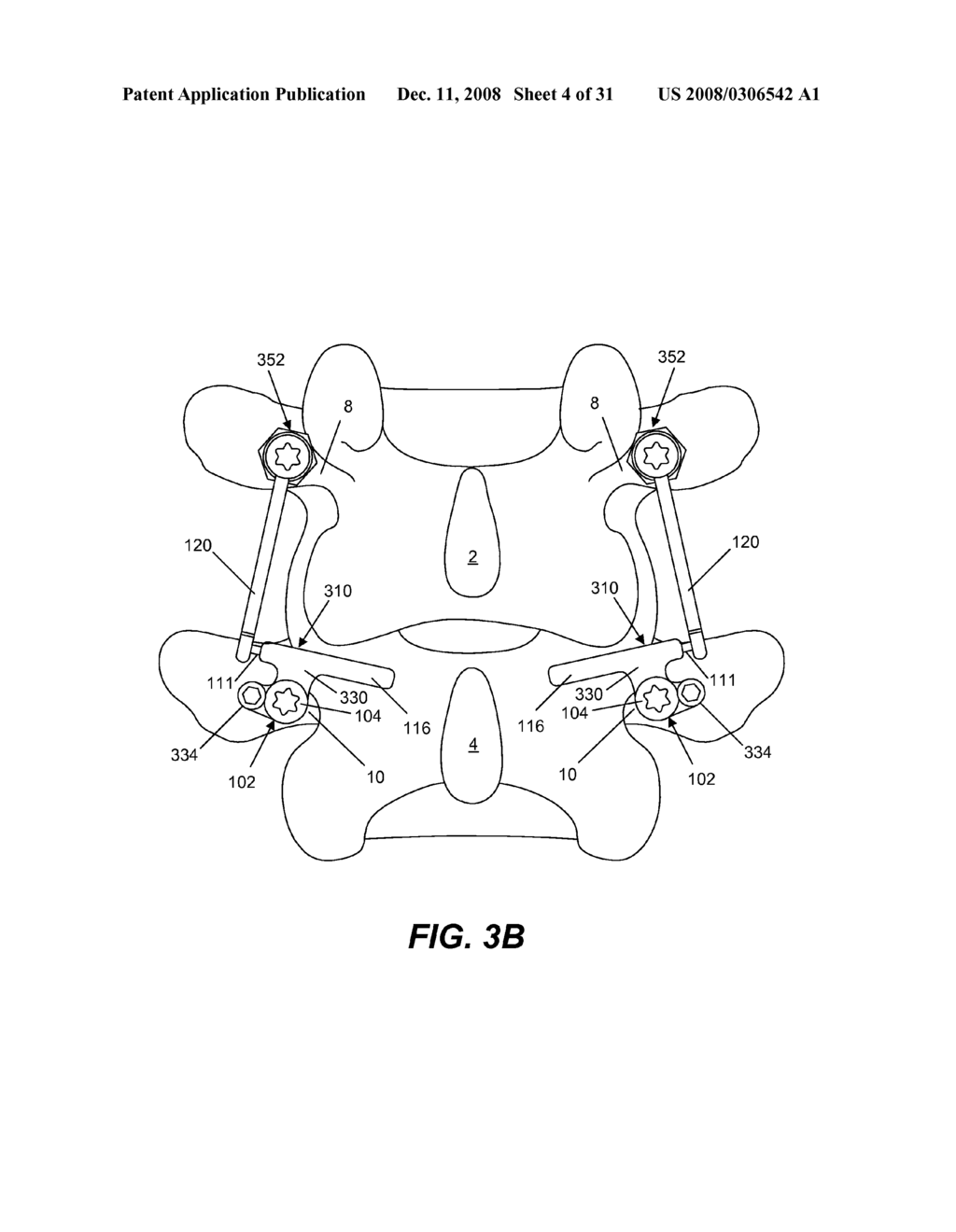 SPINE IMPLANT WITH A DEFLECTION ROD SYSTEM AND CONNECTING LINKAGES AND METHOD - diagram, schematic, and image 05