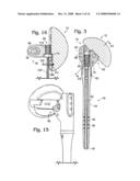 Shoulder prosthesis diagram and image