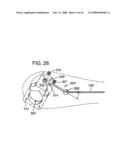 Shoulder prosthesis diagram and image