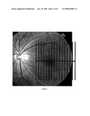 PATTERN ANALYSIS OF RETINAL MAPS FOR THE DIAGNOSIS OF OPTIC NERVE DISEASES BY OPTICAL COHERENCE TOMOGRAPHY diagram and image