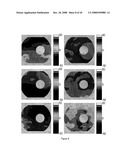 PATTERN ANALYSIS OF RETINAL MAPS FOR THE DIAGNOSIS OF OPTIC NERVE DISEASES BY OPTICAL COHERENCE TOMOGRAPHY diagram and image