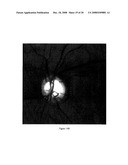 PATTERN ANALYSIS OF RETINAL MAPS FOR THE DIAGNOSIS OF OPTIC NERVE DISEASES BY OPTICAL COHERENCE TOMOGRAPHY diagram and image