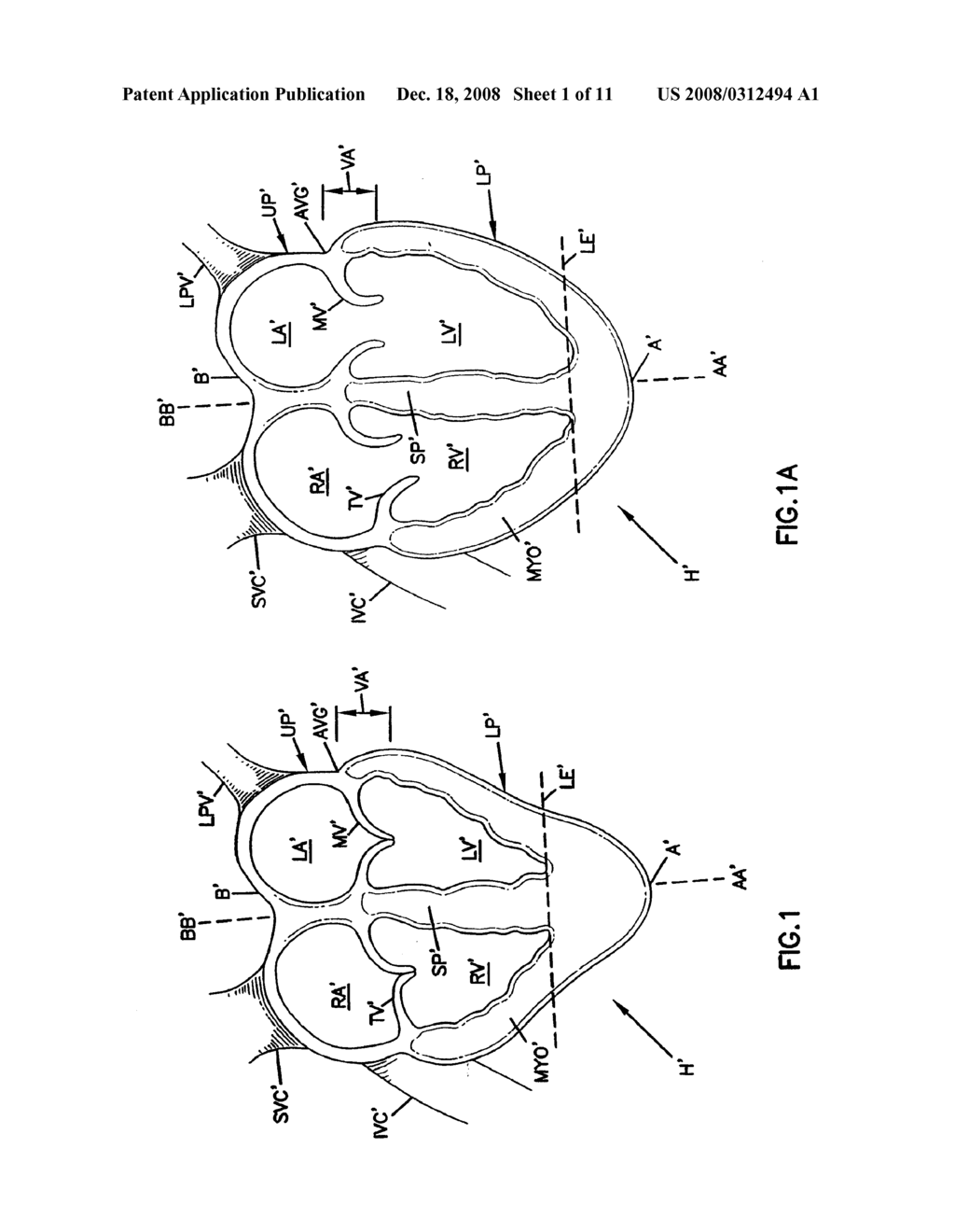 DELIVERY OF CARDIAC CONSTRAINT JACKET - diagram, schematic, and image 02