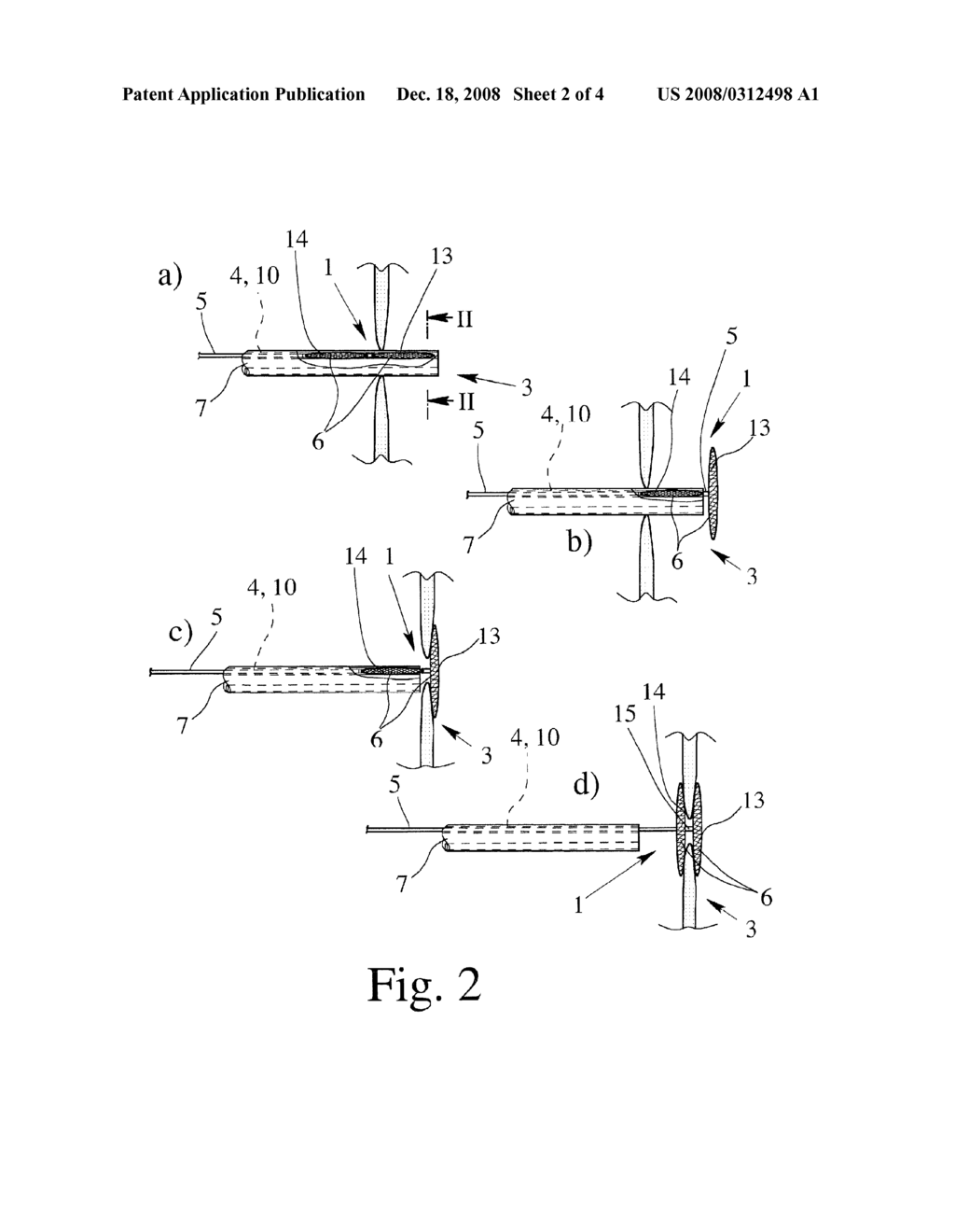 Method for performing a gastro-intestianl operation and a surgical instrument for sealing an incision in the human body - diagram, schematic, and image 03