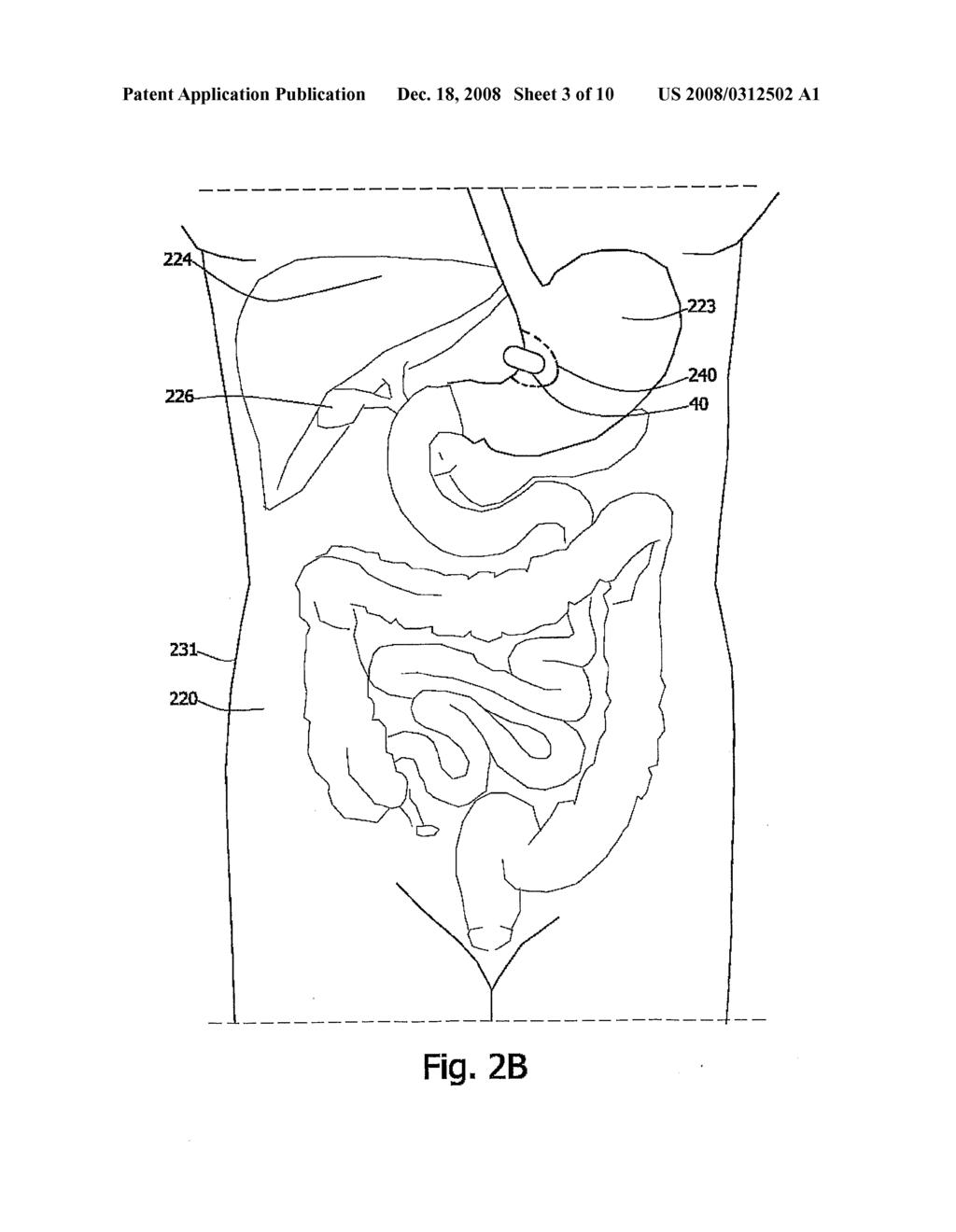 System and Device for in Vivo Procedures - diagram, schematic, and image 04