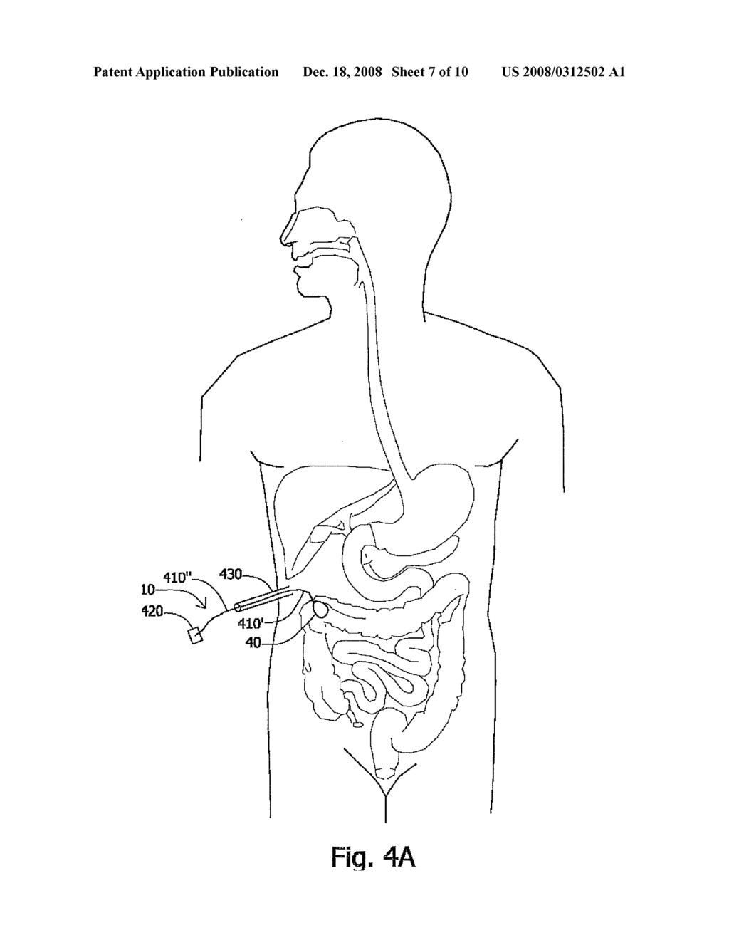 System and Device for in Vivo Procedures - diagram, schematic, and image 08