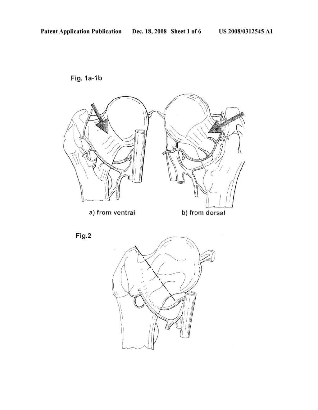 METHOD AND DEVICE FOR MEASURING BLOOD FLOW IN THE BONE AFTER A FRACTURE - diagram, schematic, and image 02