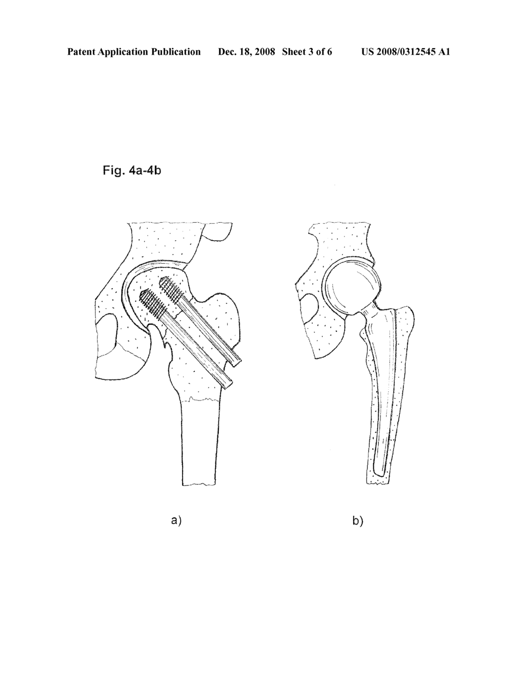 METHOD AND DEVICE FOR MEASURING BLOOD FLOW IN THE BONE AFTER A FRACTURE - diagram, schematic, and image 04