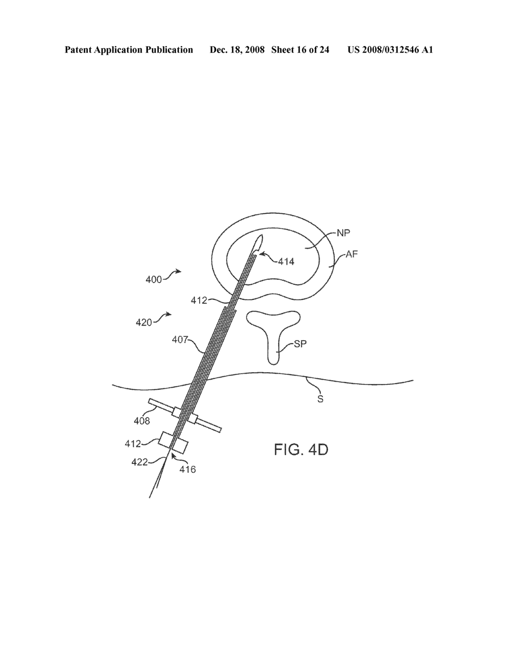 Systems and Methods for Needle Access to an Intervertebral Disc - diagram, schematic, and image 17