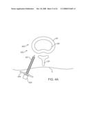 Systems and Methods for Needle Access to an Intervertebral Disc diagram and image