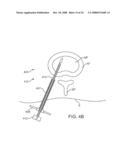 Systems and Methods for Needle Access to an Intervertebral Disc diagram and image