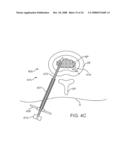 Systems and Methods for Needle Access to an Intervertebral Disc diagram and image