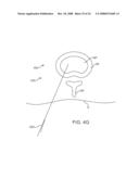 Systems and Methods for Needle Access to an Intervertebral Disc diagram and image