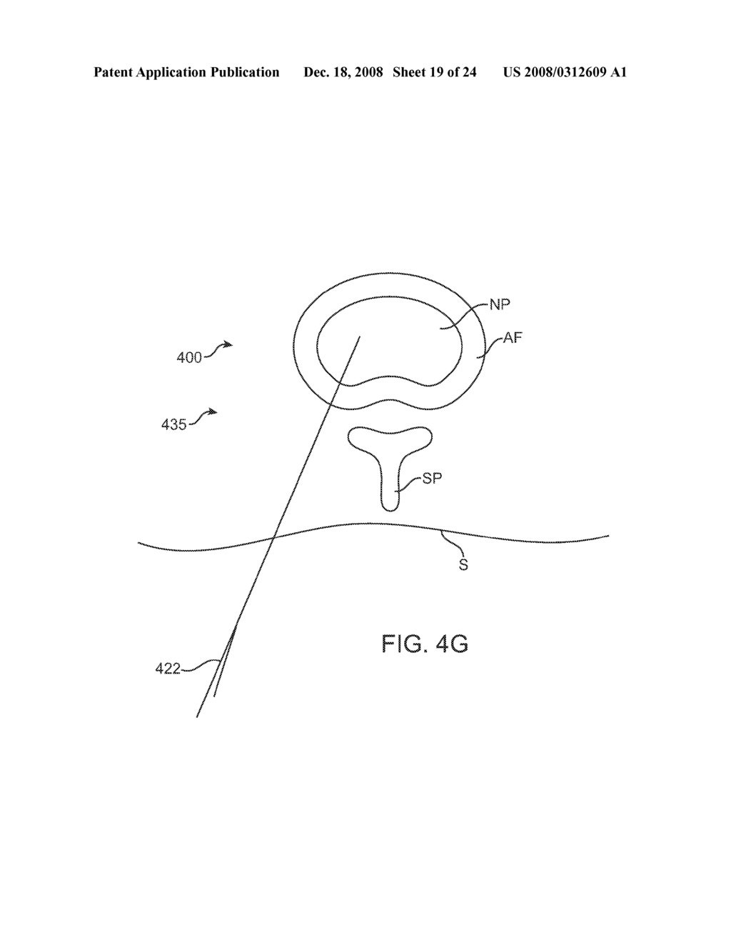 Systems and Methods for Needle Access to an Intervertebral Disc - diagram, schematic, and image 20