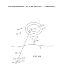 Systems and Methods for Needle Access to an Intervertebral Disc diagram and image