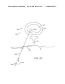 Systems and Methods for Needle Access to an Intervertebral Disc diagram and image