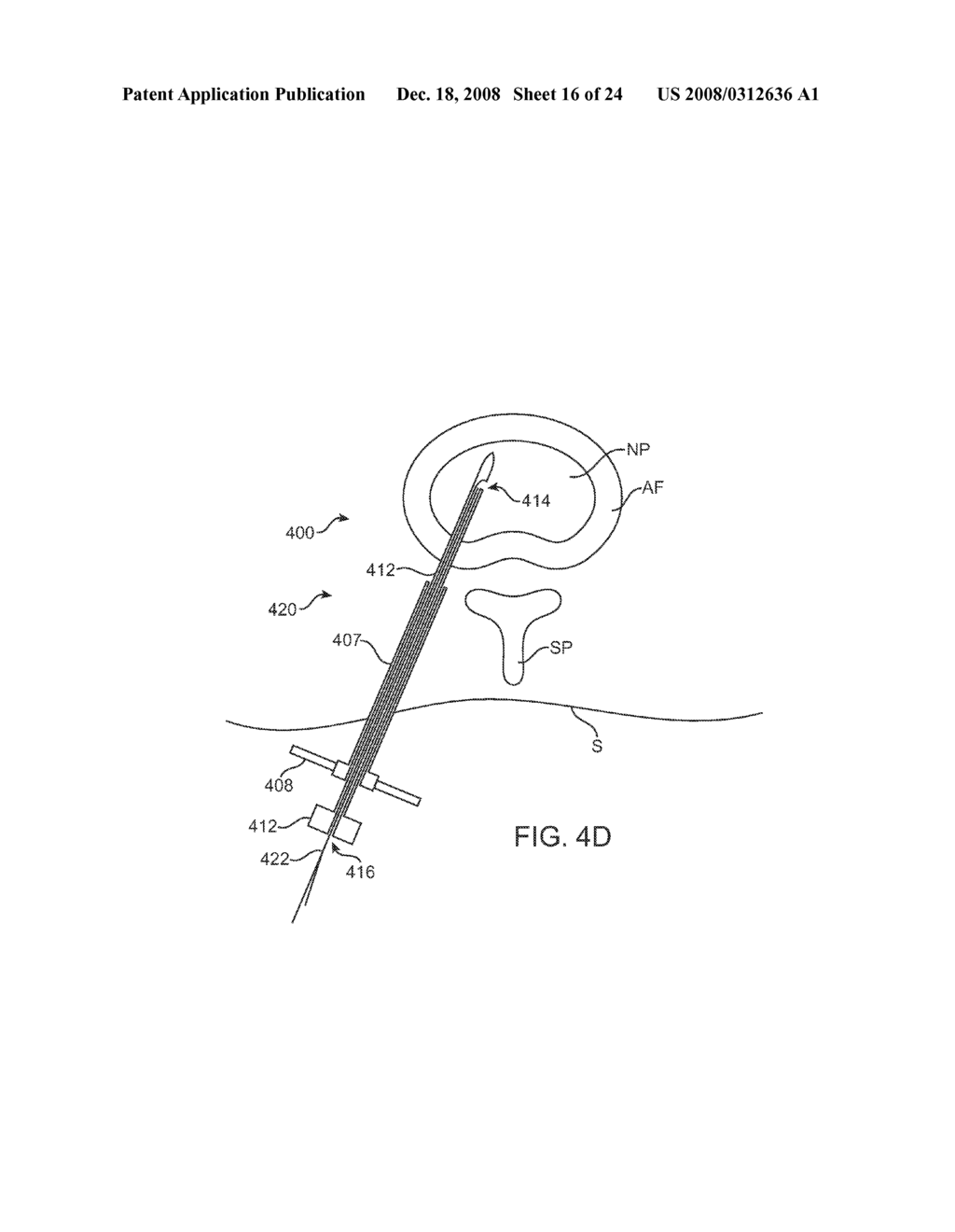 Systems and Methods for Needle Access to an Intervertebral Disc - diagram, schematic, and image 17