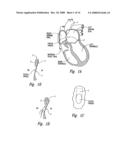 Transseptal closure of a patent foramen ovale and other cardiac defects diagram and image