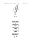 Transseptal closure of a patent foramen ovale and other cardiac defects diagram and image